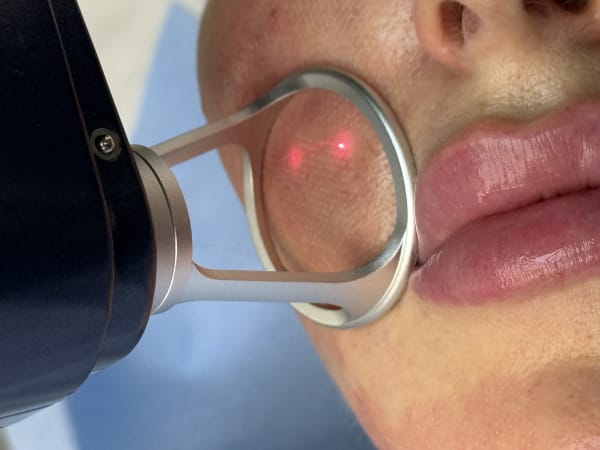Thulium fractional laser treatment in progress on a client's cheek at Creative Touch in Rotherham, showing the precise laser handpiece and red target dots.