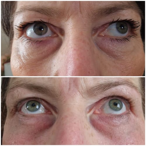 Before and after Thulium laser treatment, showing rejuvenation and reduced crepiness around a client's upper and lower eyelids.