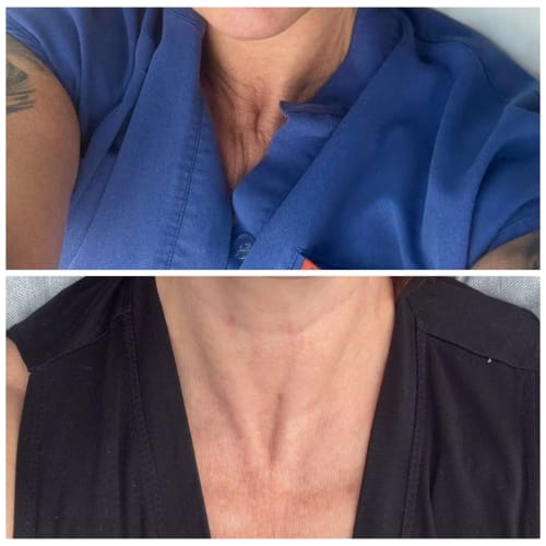 Before and after images showing significant improvement in fine lines and skin texture on a client's neck after Thulium fractional laser treatment.