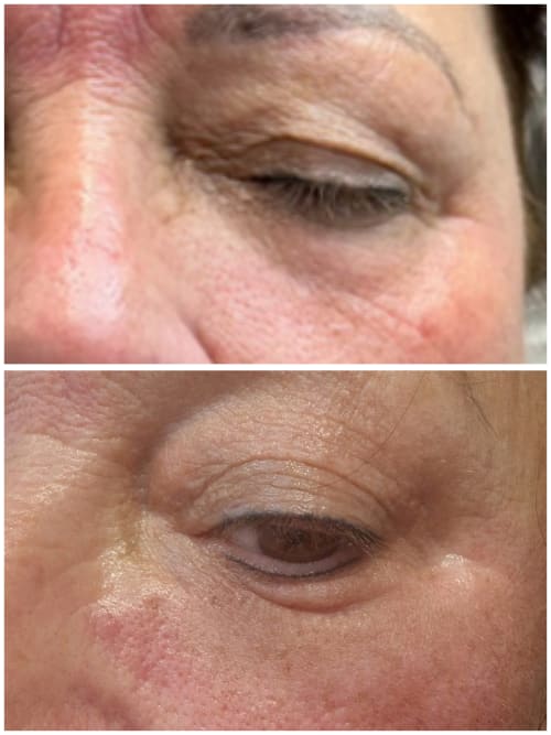 Before and after Thulium laser treatment, showing visible reduction in fine lines and improved skin tightness around the delicate eye area.