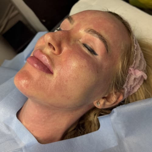 Client relaxing immediately post-treatment, showing the expected mild redness after Thulium fractional laser skin resurfacing at our Rotherham clinic.
