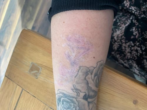Part way through the tattoo removal journey. A rose tattoo on a client's arm has faded substantially.