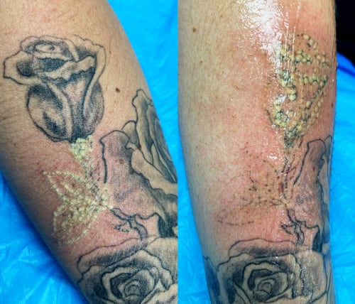 Split image of tattoo removal progression between client sessions in order to remove a rose from their arm