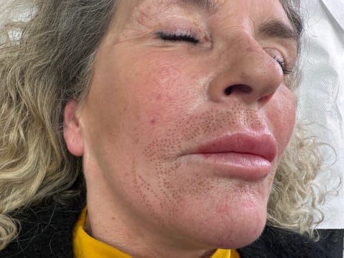 Rows of precise dots around a client's lips to lift and tighten her skin and remove lines and wrinkles