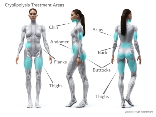 Anatomical diagram highlighting cryolipolysis treatment zones for localized fat reduction, including the submental area, abdomen, flanks, and thighs.