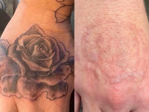 Laser Tattoo Removal in Rotherham