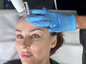 Radio Frequency Microneedling in Rotherham