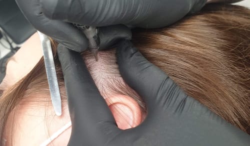 Our Rotherham client undergoing scalp micropigmentation, showing the tattoo device applying ink to the scalp
