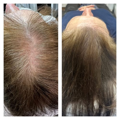 Before and after SMP comparison of a client's scalp showing a significant improvement in the appearance of hair volume and density.