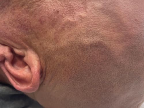 Showing a client's scalp before hair density SMP