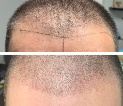 Scalp Micropigmentation (SMP) in Rotherham, Sheffield