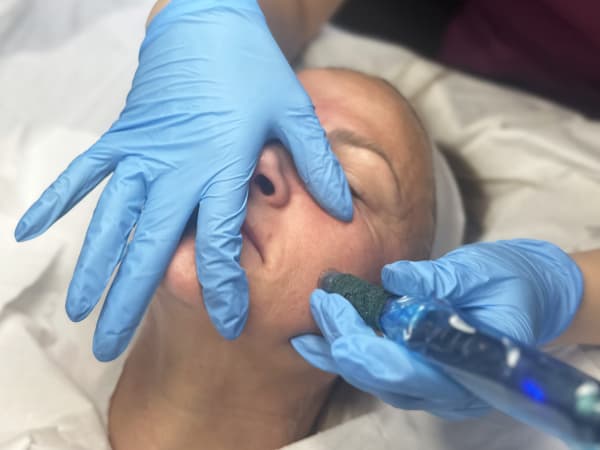 Portrait of one of our clients receiving microneedling treatment at the hands of Grace Bayliss