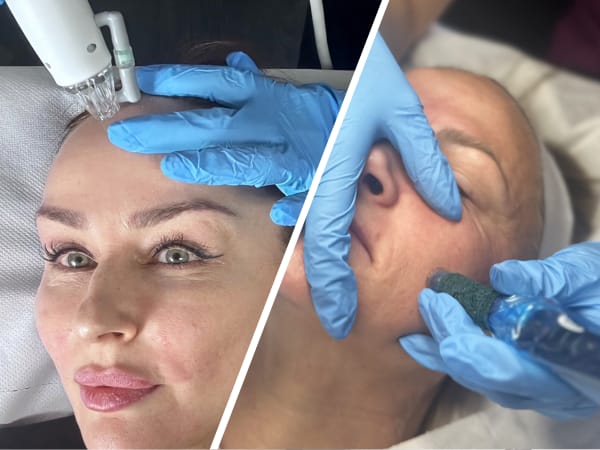 Split image of a client receiving microneedling treatment and another receiving radiofrequency microneedling