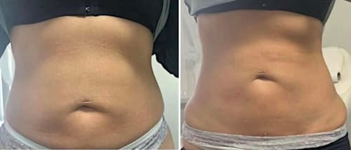 Fat freeze: before and after. Results show a dramatic reduction in abdominal fat