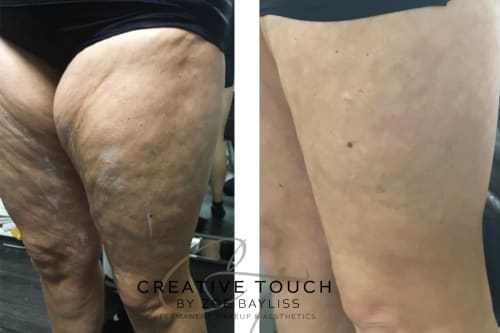 A client's legs before and after treatment, showing an incredible reduction in total fat and especially lumpy cellulite, with much smoother, healthier looking skin.