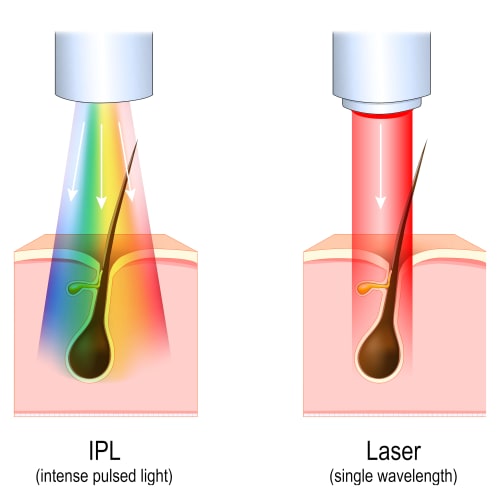 Illustration of the light wavelength difference between IPL and Laser hair removal devices.