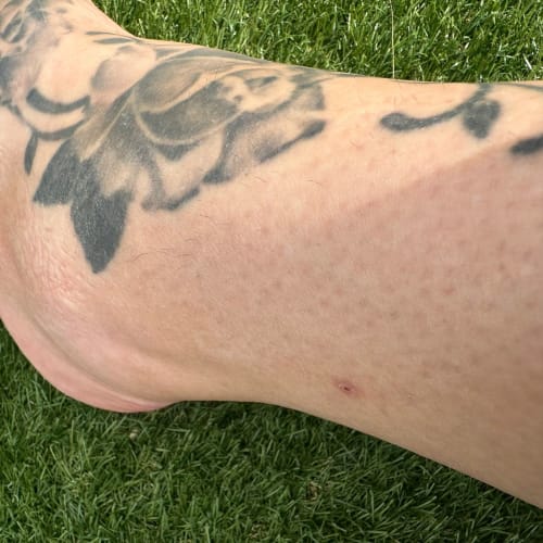 Close-up of a client's leg showing the difference in dark hair regrowth between treated and untreated areas of her skin