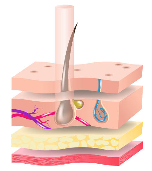 Illustration of skin layers with a focused beam of laser light targeting the hair