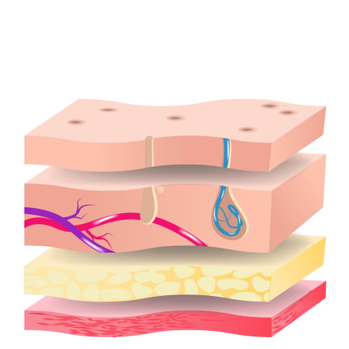 Illustration of skin layers with with no hair regrowth