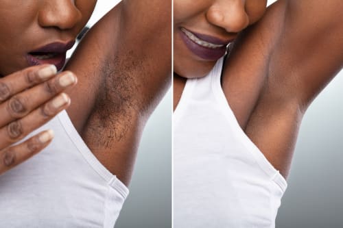 Before and after: underarm laser hair removal on darker skin