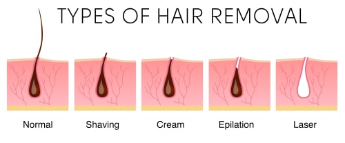 Infographic showing the difference between hair removal methods