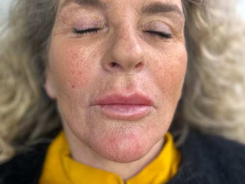 A few days after the meso dissolver was injected, the migrated filler has done its job and the client's lips look far more natural