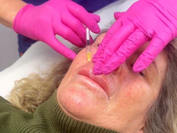 Injecting a meso dissolver into a client's upper lip to remove migrated lip filler.