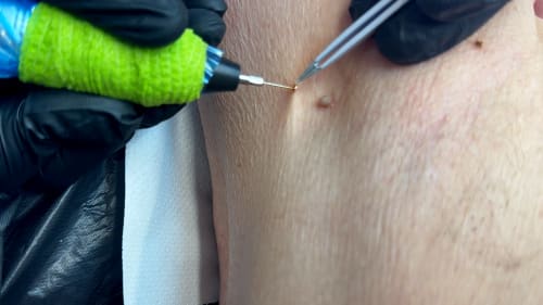 A Rotherham client having skin tags removed. Close-up detail of armpit skin tags being cauterised and removed.