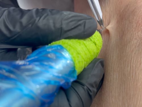 Close-up of a skin tag being removed from one of our clients. The skin tag is being held away from the skin with tweezers and the neck of it is about to be cauterised