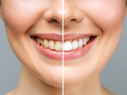 Laser Teeth Whitening in Rotherham, Sheffield