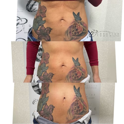 The results of fat cavitation from start to finish across 3 images