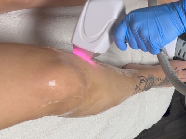 A client undergoing laser hair removal treatment on her legs