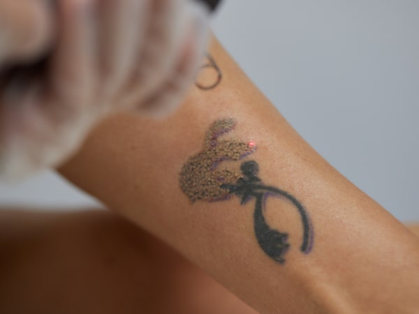 Close-up of the tattoo on a young woman's leg being removed by a laser