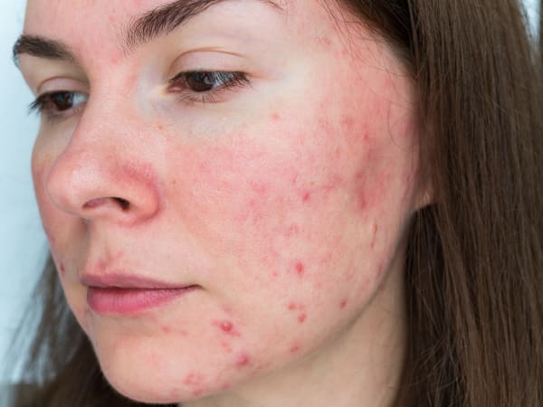 Close-up of a young woman with redness of the skin and small lumpy red spots on the face, typical of papulopustular rosacea.